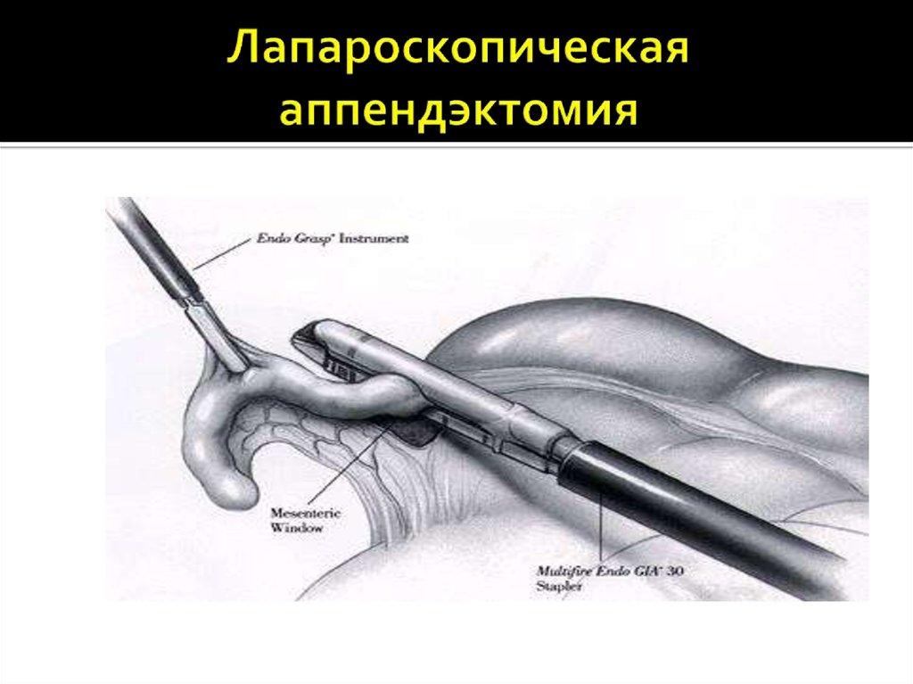 Сколько длится удаление. Лапароскопическая аппендэктомия этапы. Лигатурная аппендэктомия. Лапароскопия аппендэктомия. Лапароскопическая аппендэктомия этапы операции.