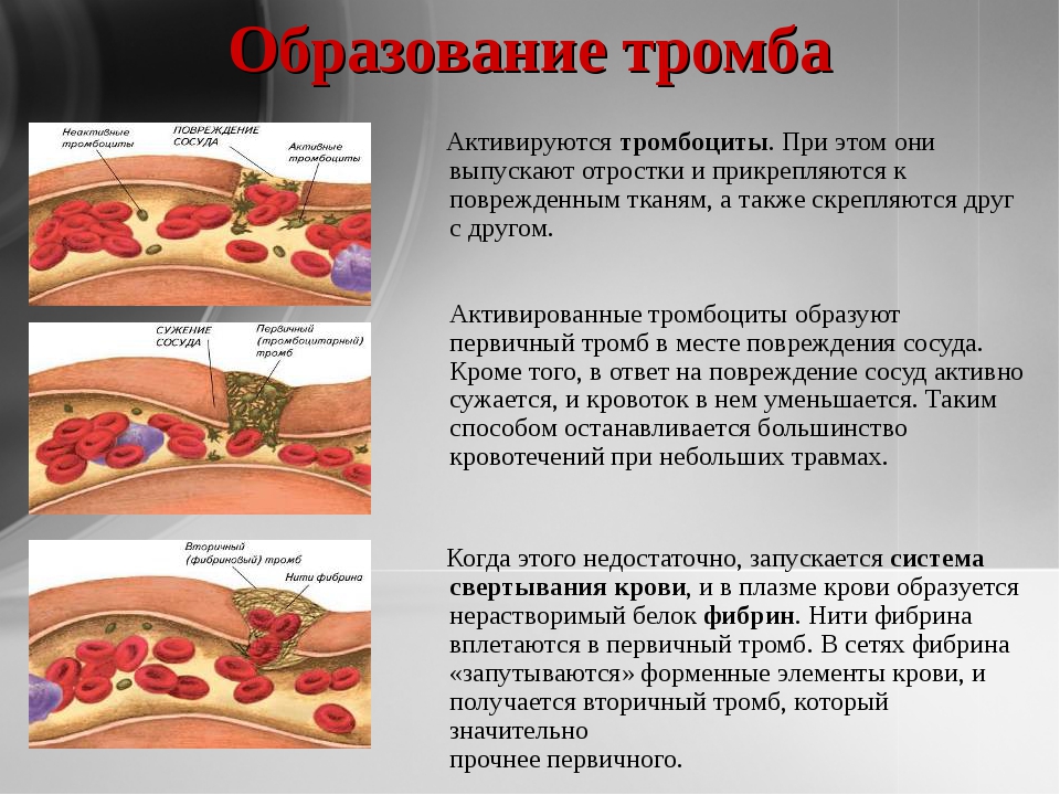 Место повреждения. Образование тромбов в крови. Процесс образования тромба. Тромбоциты образуют тромб.