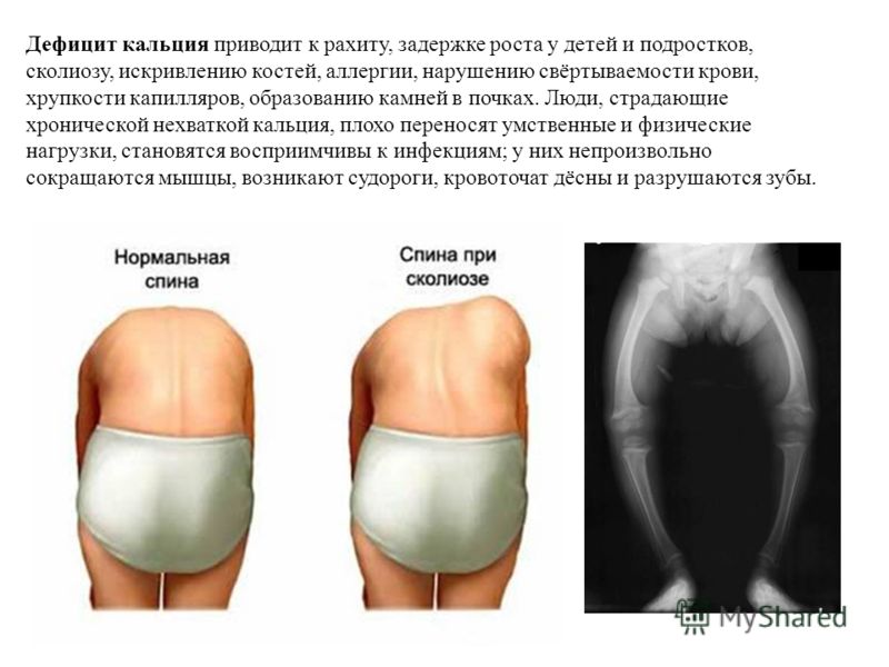 Дефицит кальция у детей