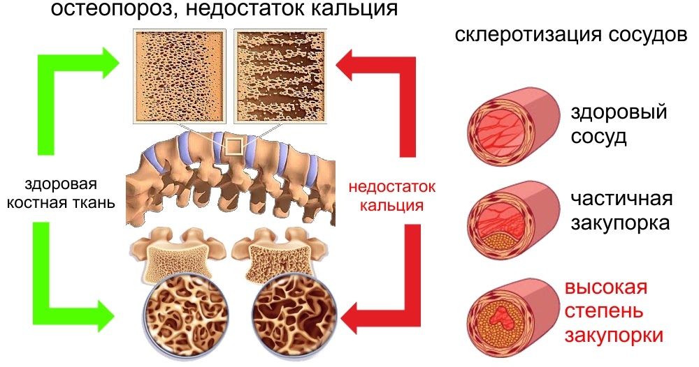 Недостаток кальция фото