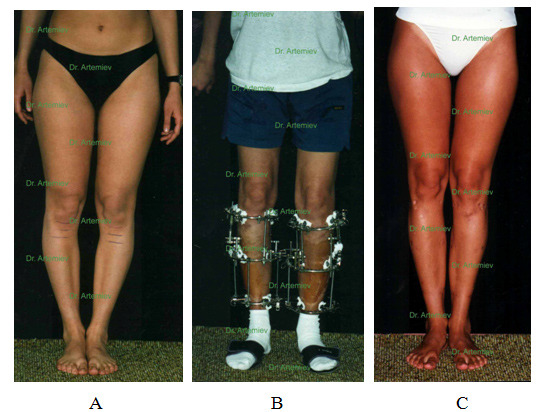 Операция по уменьшению роста. Удлинение ног аппаратом Илизарова. Аппарат Илизарова исправление кривизны ног. Аппарат евлизаровп удлигение ног. Аппарат Илизарова удлинение конечности.