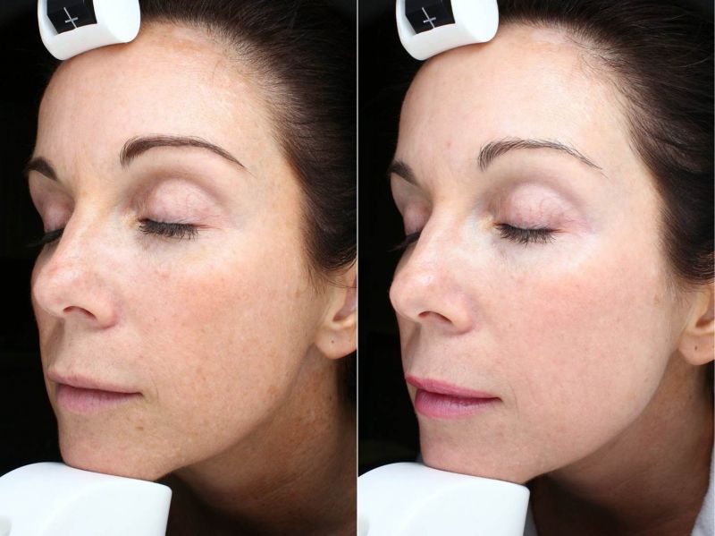 Лазерное отбеливание лица до и после кожи фото