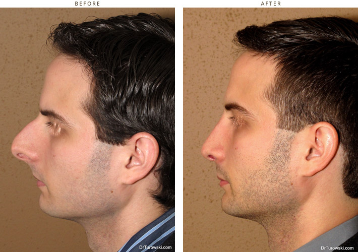 Широкий мужской нос. Ринопластика до и после мужчины.