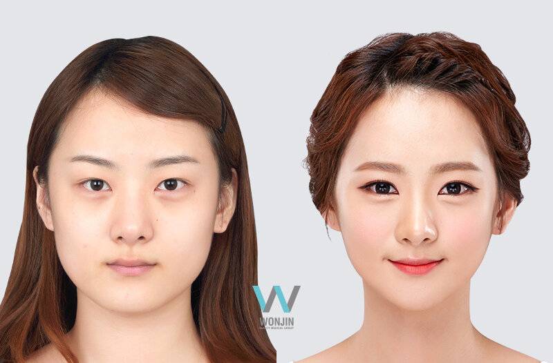 Изменение формы глаза. Корейское увеличение глаз. Увеличение глаз в Корее. Глаза корейцев увеличение. Процедуры для увеличения глаз.