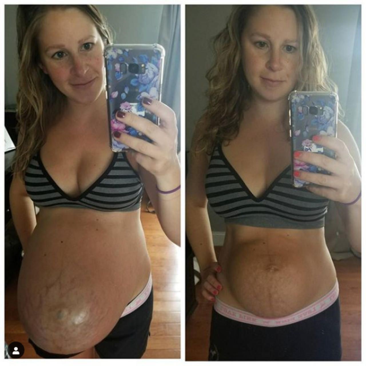 6 недель после родов. Живот после беременности. Живот сразу после родов.