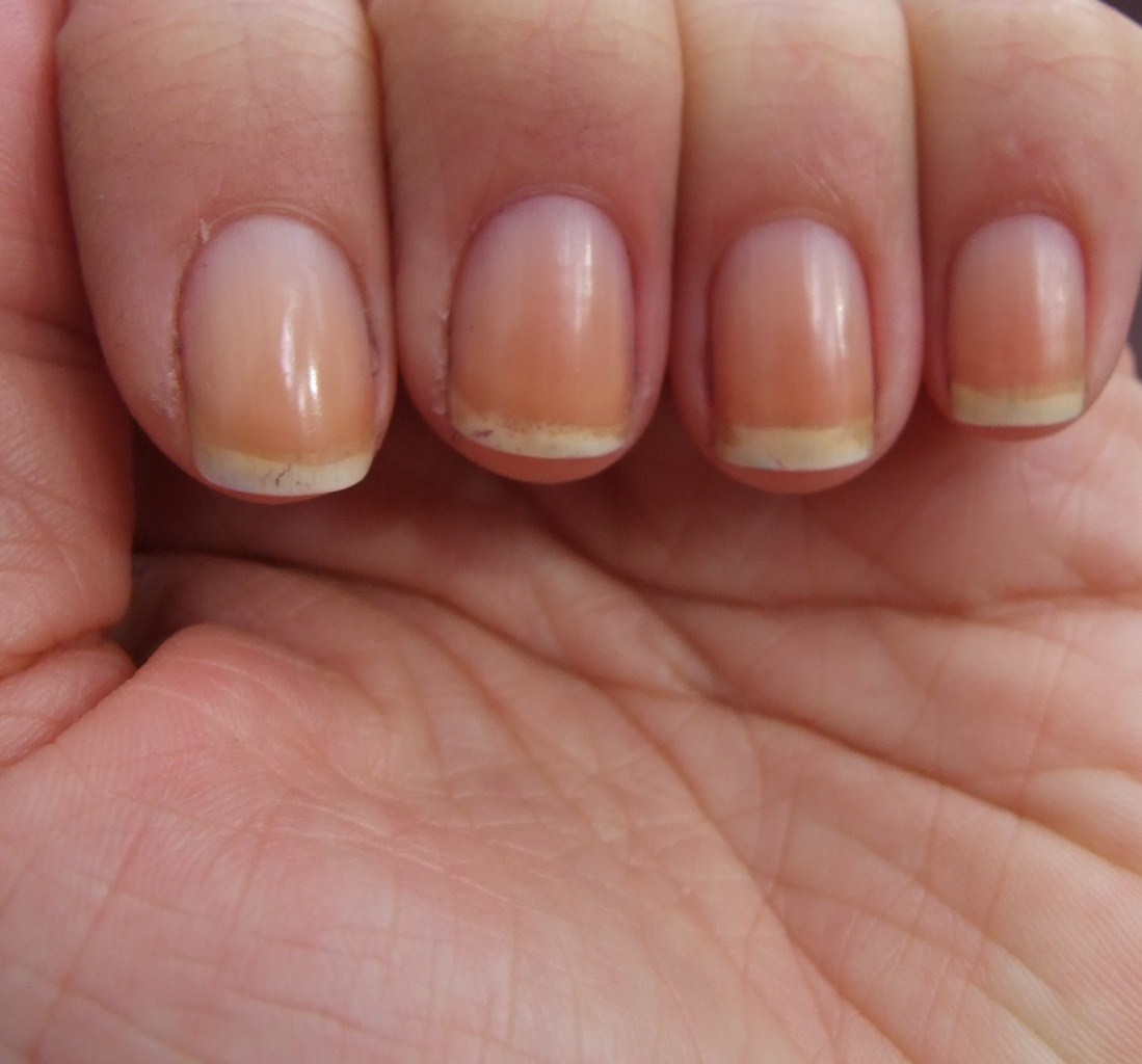 Почему ногти становятся тонкими. Онихолизис-дистрофия ногтевой пластины. Ониходистрофия - онихолизис.. Онихолизис псориазный.